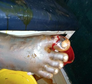 Morsures et envenimations Gestes de 1er recours